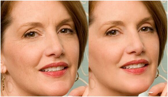 Plasma before and after skin rejuvenation
