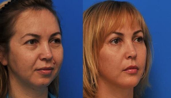 Tightening before and after skin rejuvenation photo 1