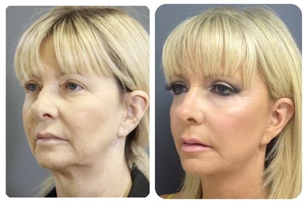 Tightening before and after skin rejuvenation photo 2