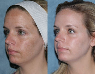 Photos before and after the fractional rejuvenation of the face
