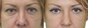 Photos before and after eyelid contour