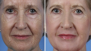 Fractional facial rejuvenation before and after taking photos