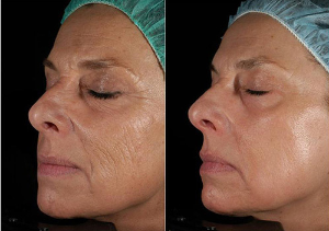 Laser skin rejuvenation before after