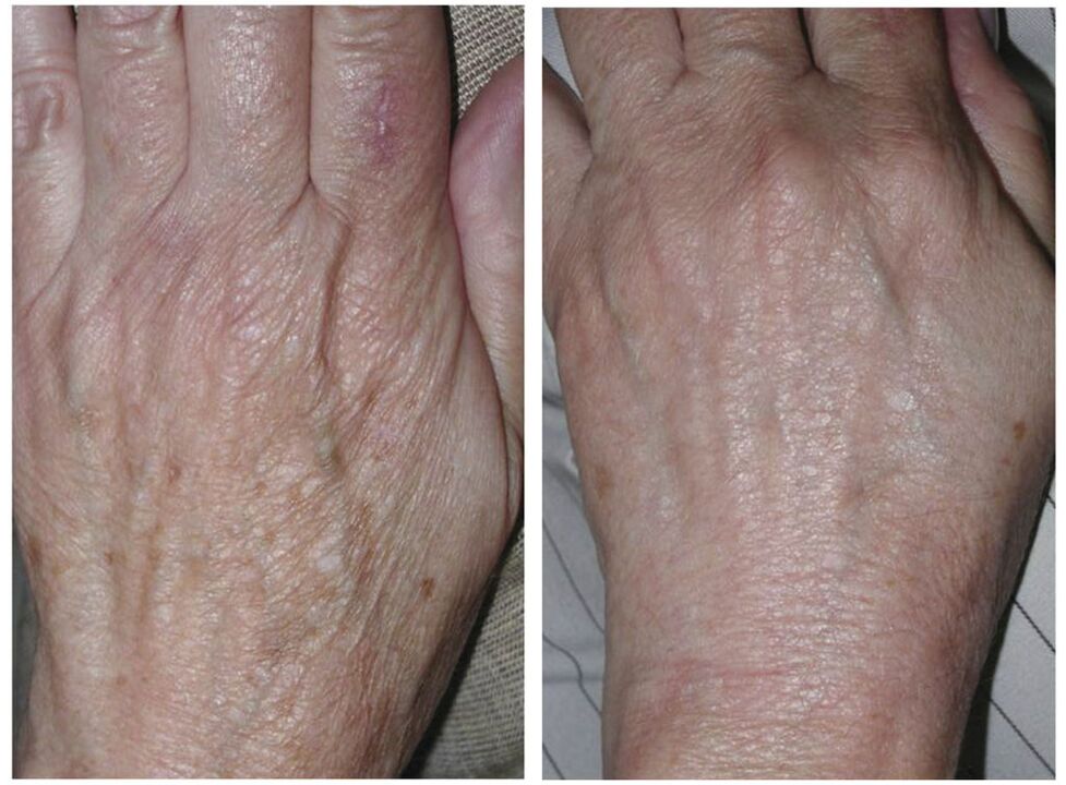 Laser rejuvenation of hands before and after taking photos